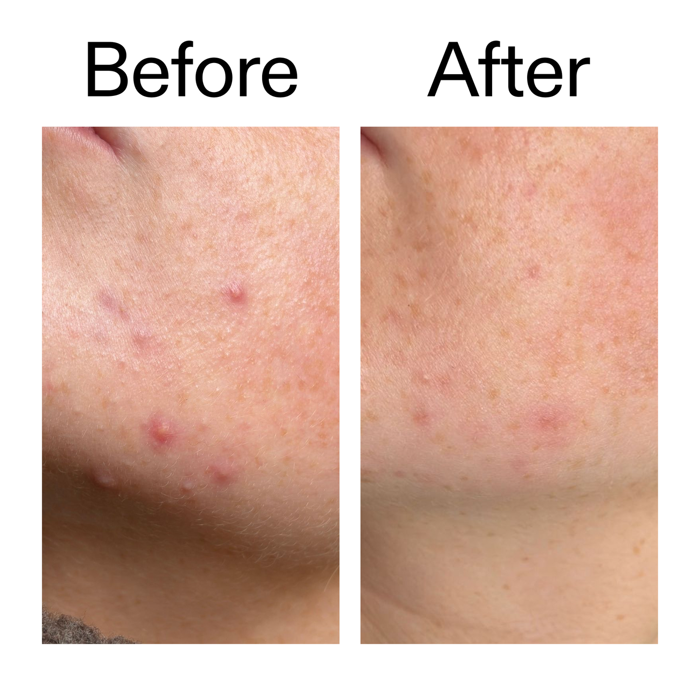 10-azelaic-acid-serum-for-redness-relief-c2 B_A_1_PPAGE.png
