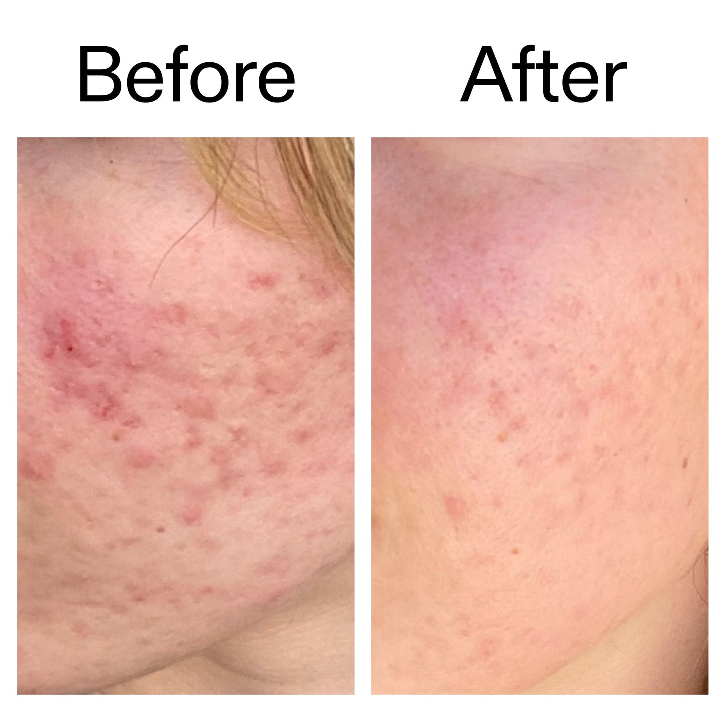 10-azelaic-acid-serum-for-redness-relief-c2 Azealic_Acid_Serum_B_A_Ppage_2000_x_2000.jpg