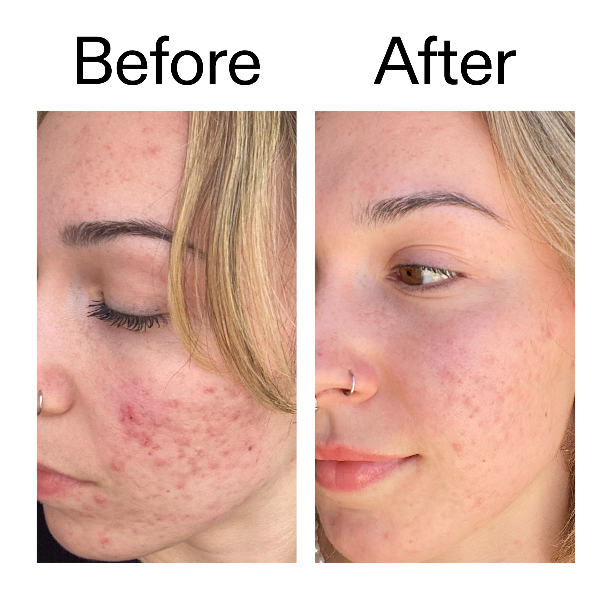 10-azelaic-acid-serum-for-redness-relief-c2 B_A_2_PPAGE.png