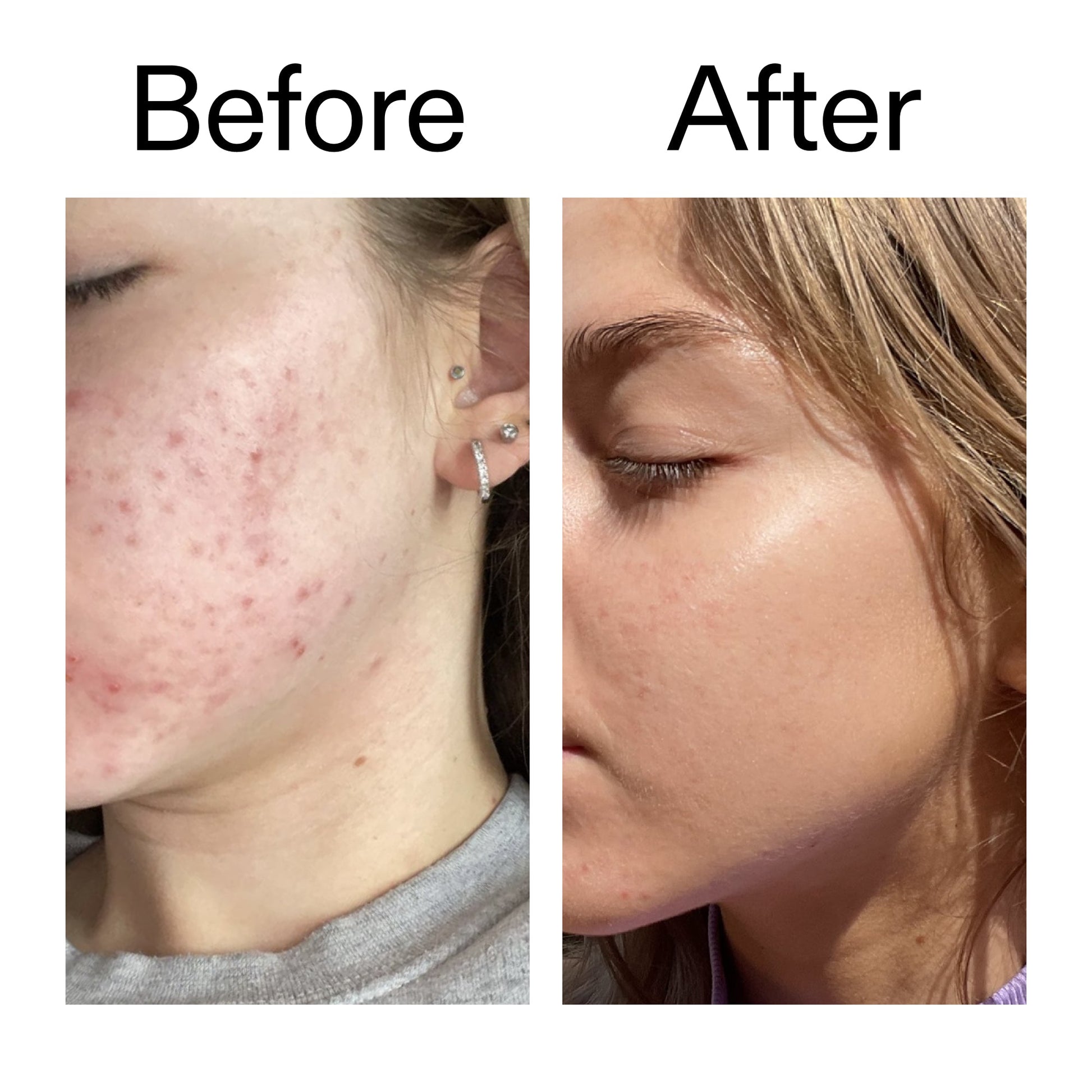 beta-hydroxy-acid-bha-serum-e1 Beta_Hydroxy_Acid_Serum_Before_After_2000x2000_96fda3e5-938d-49ef-bcf2-a0fa6ece4e2c.jpg