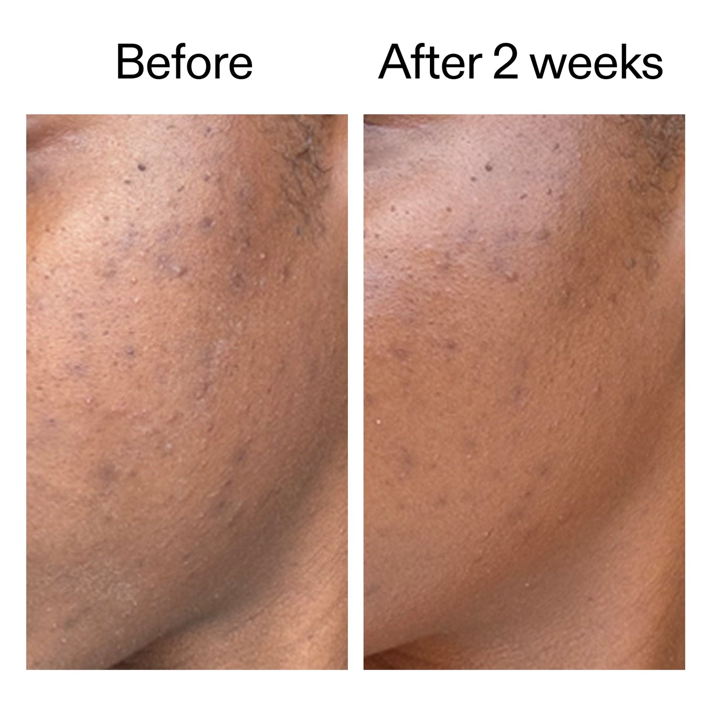 360-acne-clearing-serum-j3 DIOICB_A2000x2000.jpg