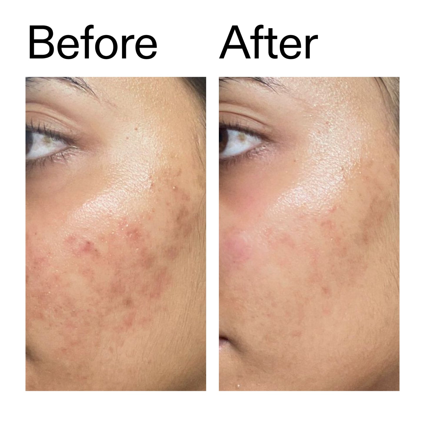 ectoin-hydro-barrier-serum-a8 Ectoin_Hydro-barrier_Serum__Before_After_2000x2000_34261920-d004-48d0-9c7b-8e1c15971bfd.jpg