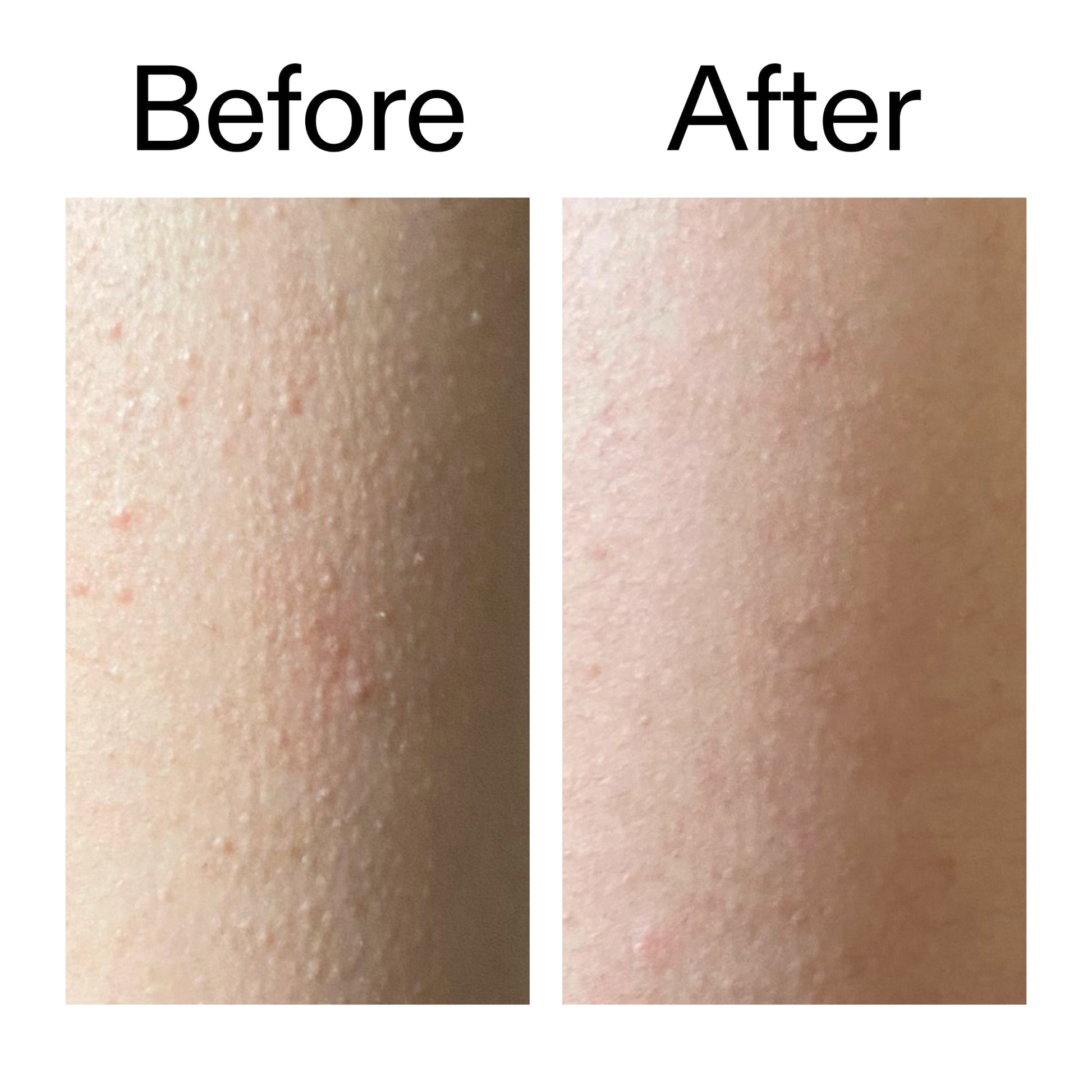 glycolic-acid-exfoliating-body-stick-g5 Glycolic_Acid_Exfoliating_Body_Stick_Before_After_V2_2000x2000_2e4ba052-94f6-4d56-82df-7bdb5b2df7ae.jpg