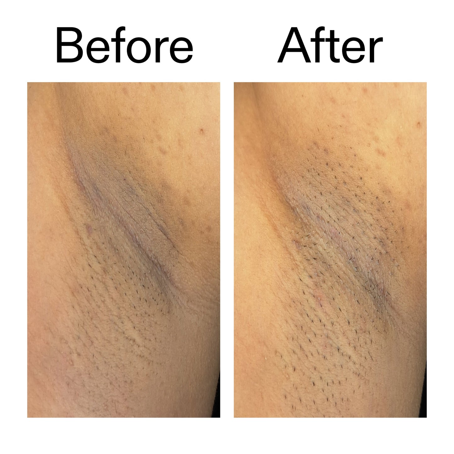 glycolic-acid-exfoliating-body-stick-duo-t6 Glycolic_Acid_Exfoliating_Body_Stick_Before_After_V3_2000x2000_ea919cd9-1439-4a46-82a0-76200eb5bb42.jpg