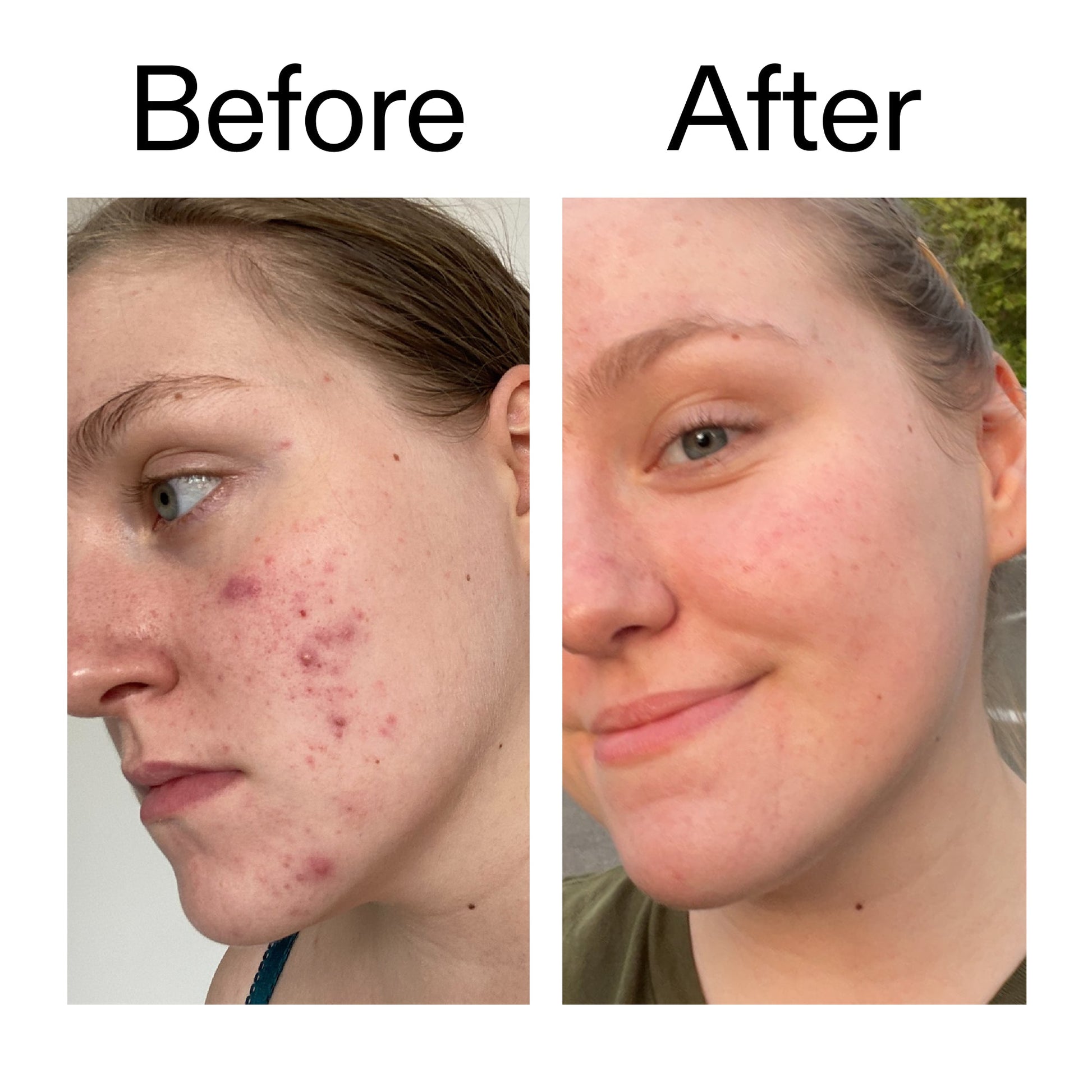 glycolic-acid-toner-z9 Glycolic_Acid_Toner_Before_After_2000x2000_49f0b9f7-e71b-4b2e-a8f8-2ea4b73247bb.jpg