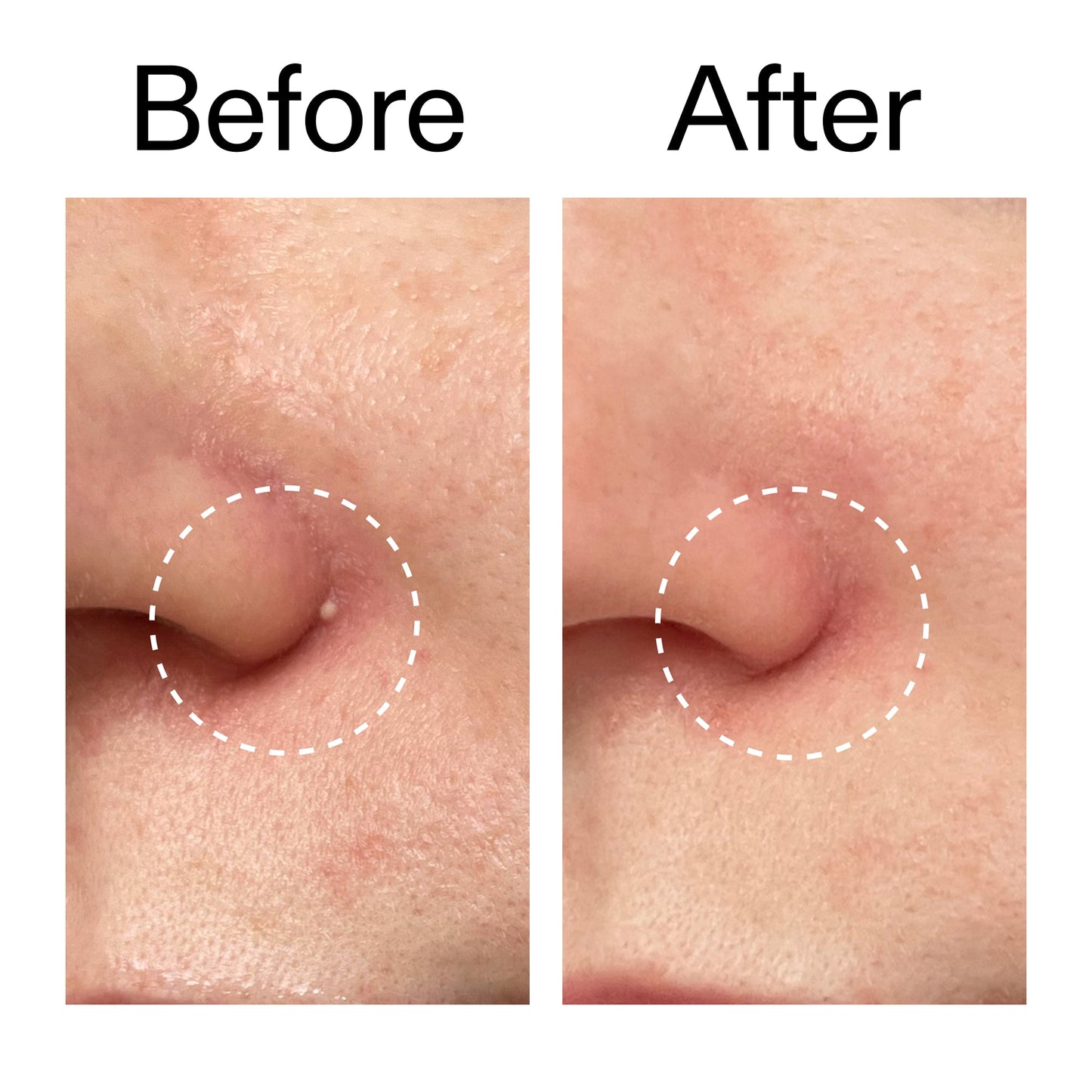 hydrocolloid-invisible-pimple-patches-pack-of-22-m7 Hydrocolloid_Invisible_Pimple_Patches_Before_After_2000x2000_b02aa37b-c78a-4682-91de-9135af5bb7df.jpg