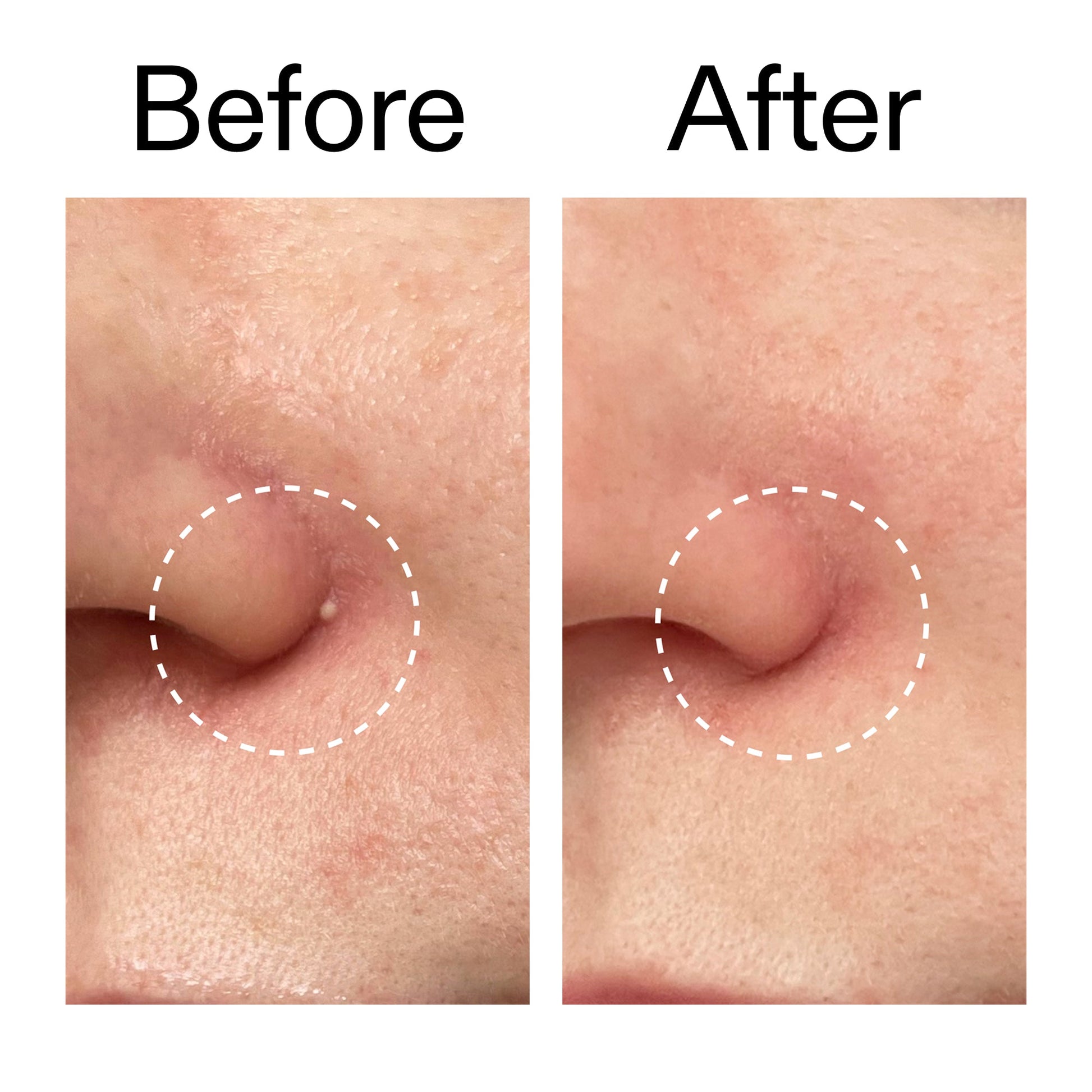 hydrocolloid-invisible-pimple-patches-pack-of-44-j9 Hydrocolloid_Invisible_Pimple_Patches_Before_After_2000x2000_b02aa37b-c78a-4682-91de-9135af5bb7df.jpg