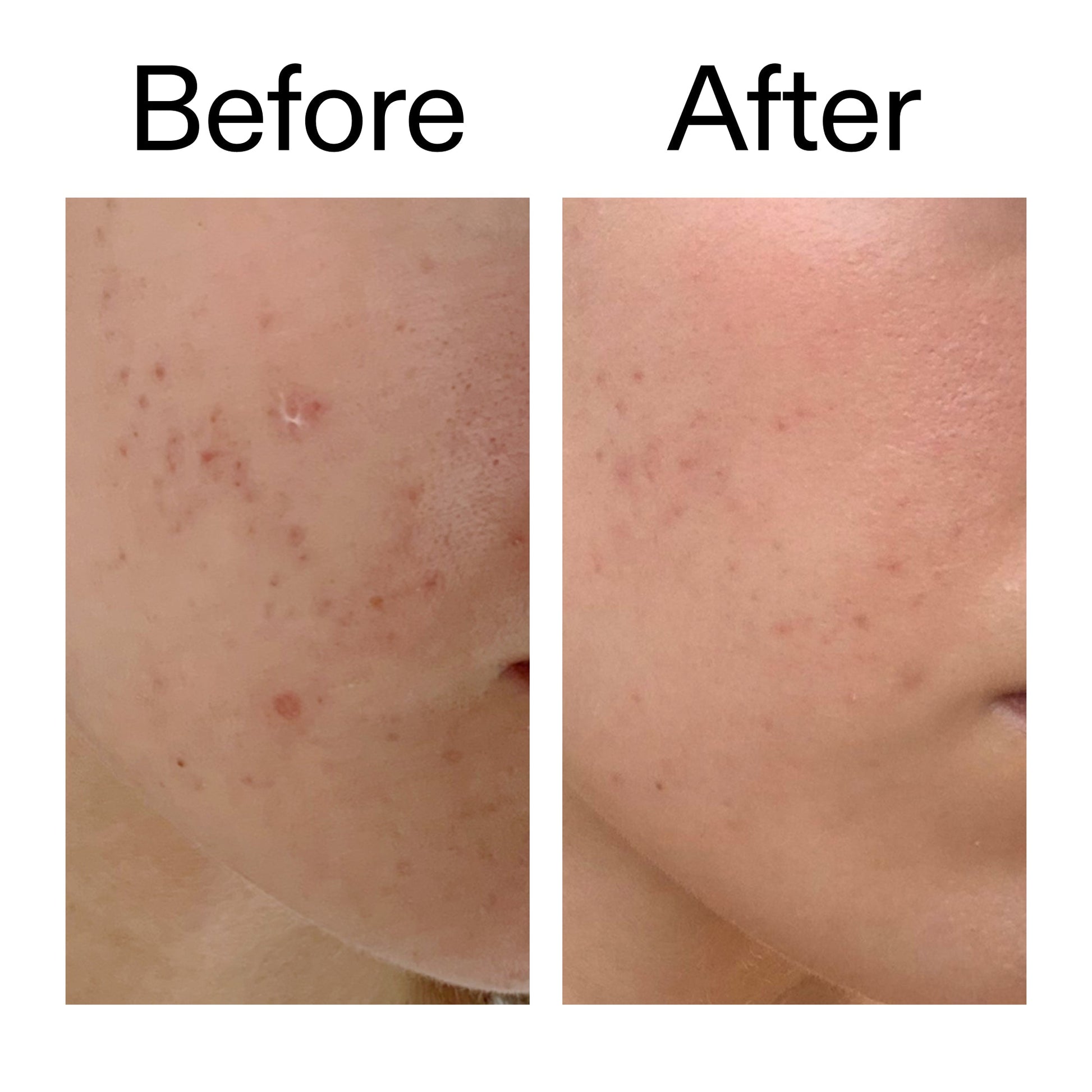 mandelic-acid-treatment-n1 Mandelic_Acid_Treatment_Before_After_2000x2000_4885ac6e-c5d7-4279-a72a-1417af7dce35.jpg