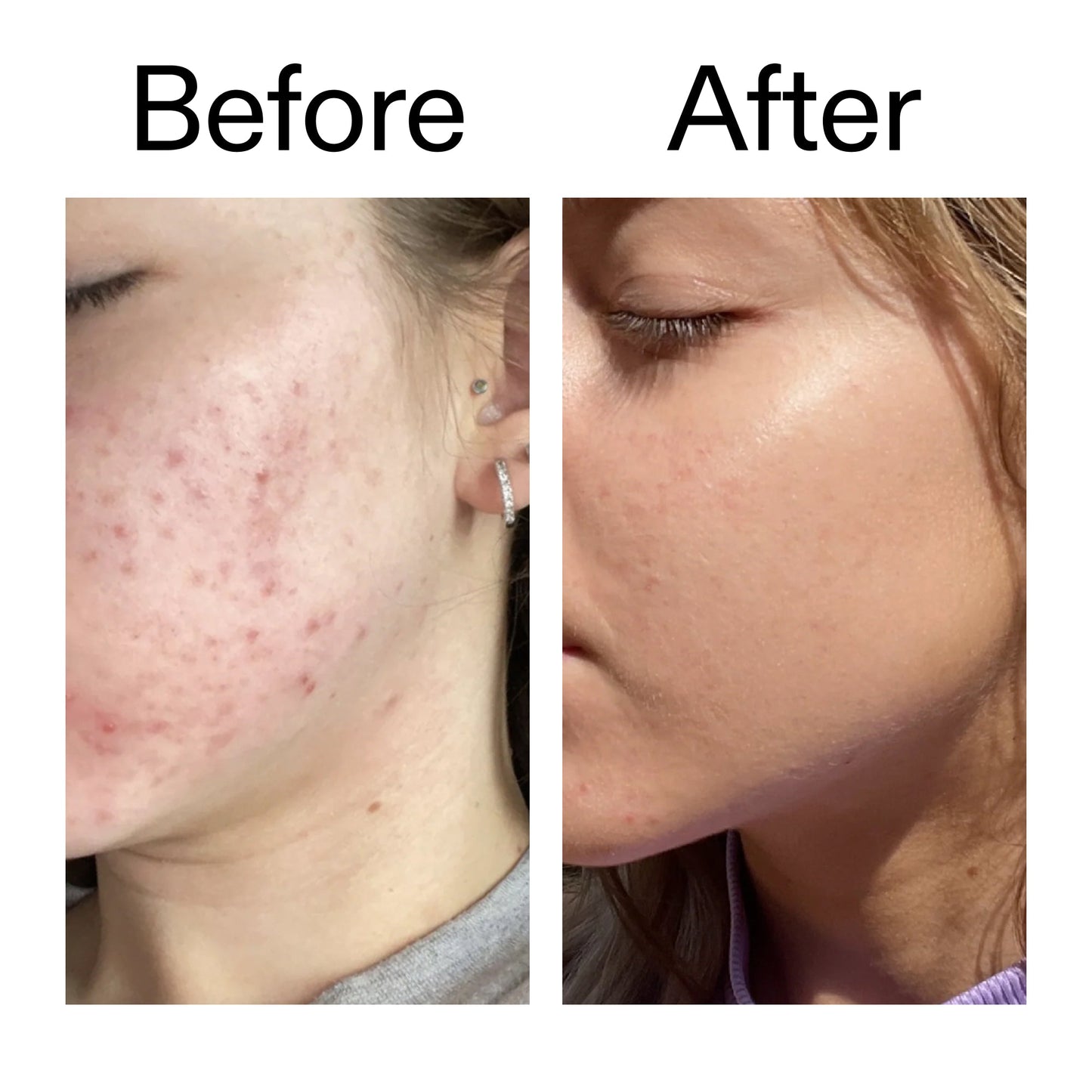 10-niacinamide-serum-o7 Niacinamide_Serum_Before_After_2000x2000_bde32455-9e7d-448e-b053-bef41504f0a9.jpg