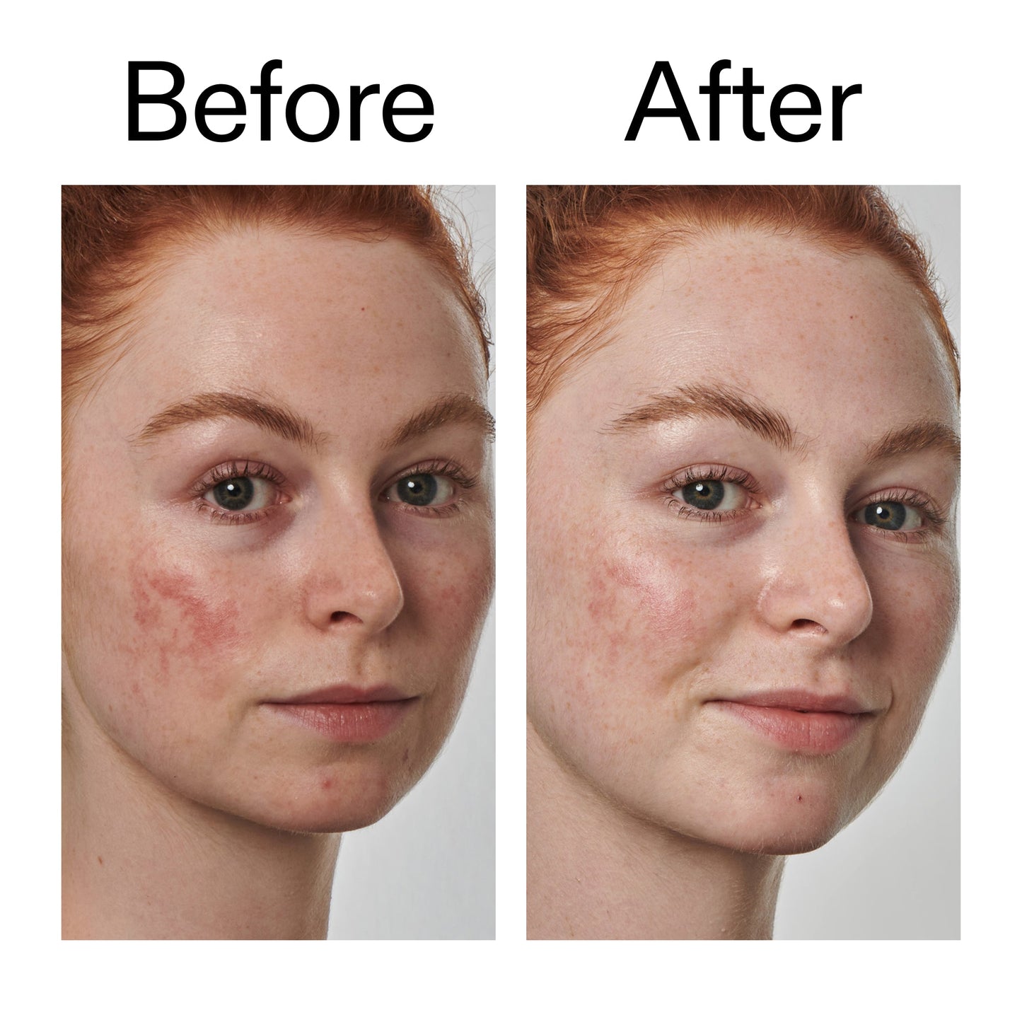 10-azelaic-acid-serum-for-redness-relief-c2 Redness_Relief_Serum_Before_After_2000x2000_3334dc9a-cce9-4e00-8aec-7ad89ca051f2.jpg