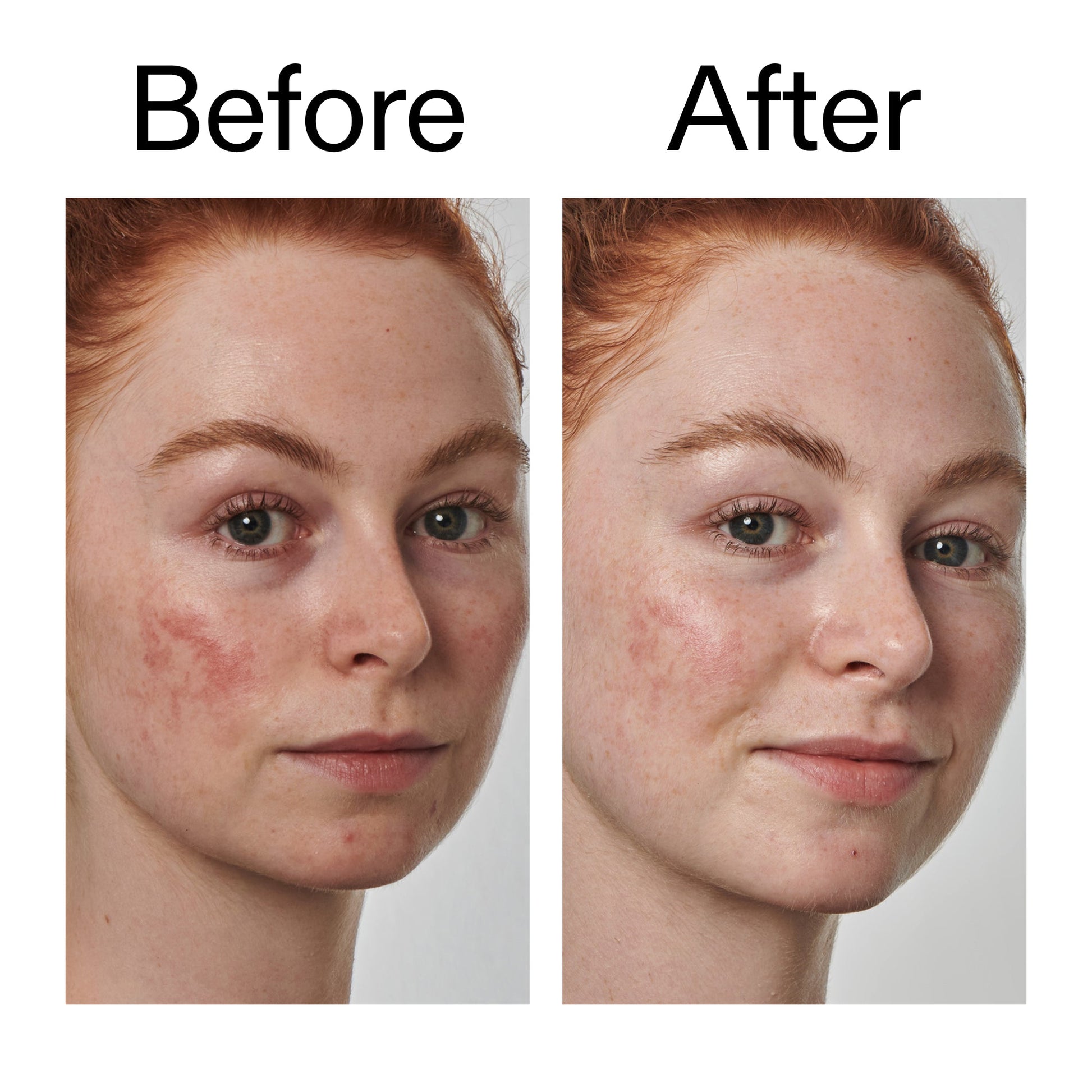 10-azelaic-acid-serum-for-redness-relief-c2 Redness_Relief_Serum_Before_After_2000x2000_3334dc9a-cce9-4e00-8aec-7ad89ca051f2.jpg