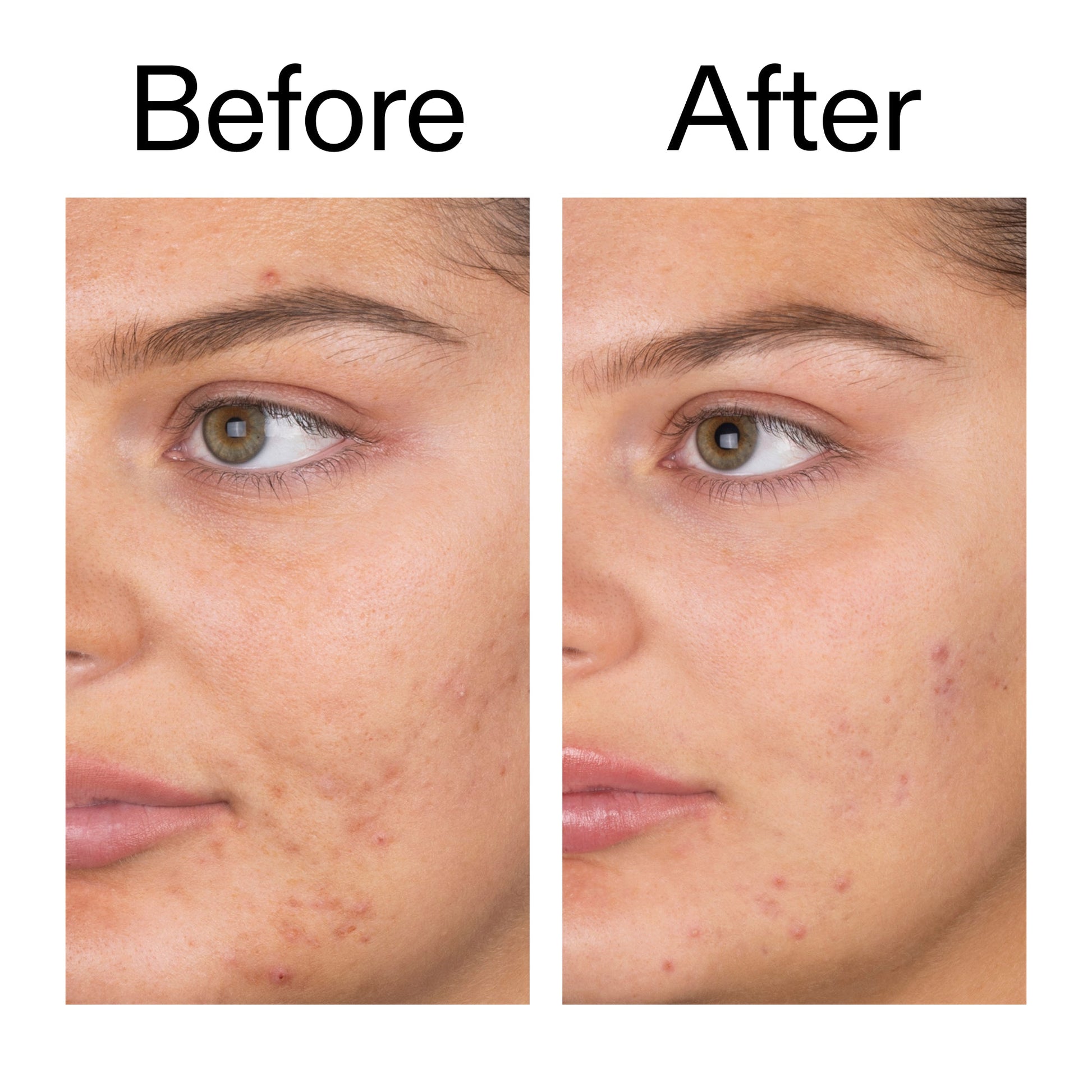 salicylic-acid-cleanser-duo-z5 Salicylic_Acid_Cleanser_-_150ml_Before_After_2000x2000_e7230494-853f-4b07-82b1-27669104c995.jpg