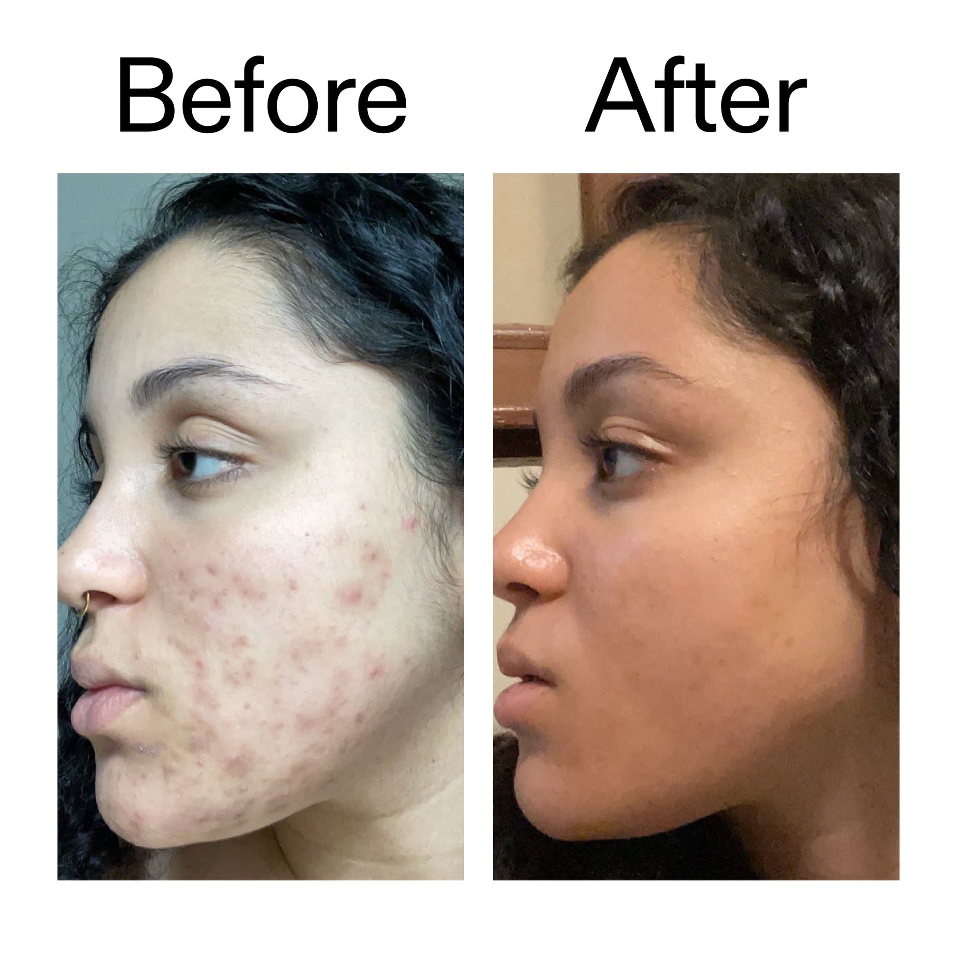 tranexamic-acid-serum-j2 Tranexamic_Acid_Serum_Before_After_2000x2000_98ebc8be-77b0-4843-8a22-90790ebe918b.jpg